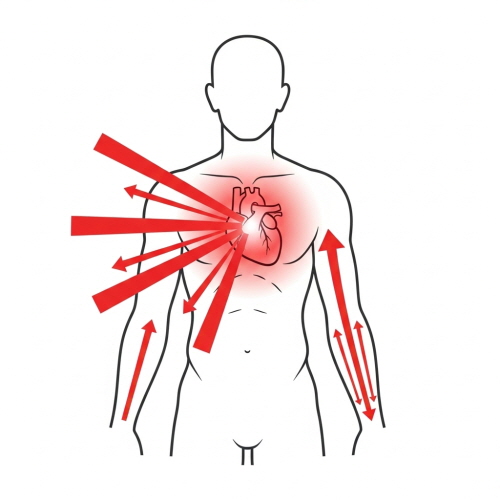 심근경색 전조증상