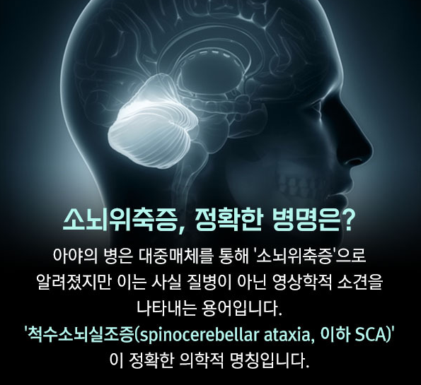 소뇌위축증