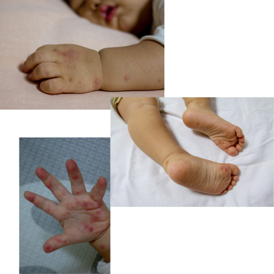 수족구병의 증상