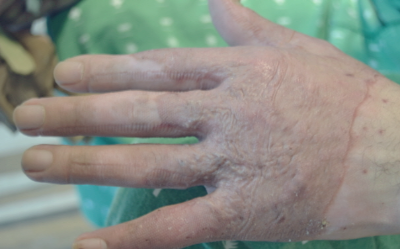 화상입었을때 대처법