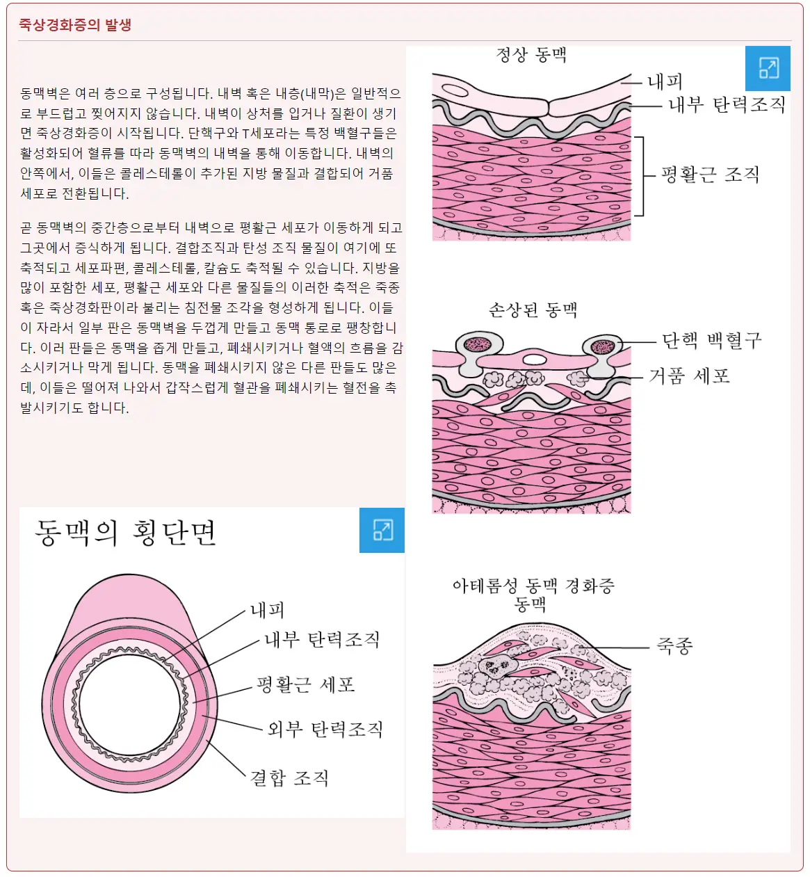 죽상경화증의 발생 순서 (출처 : MSD 매뉴얼)