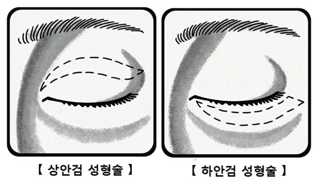 안검하수 증상부터 원인, 치료까지 -눈꺼풀 처짐