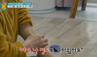 가려움증