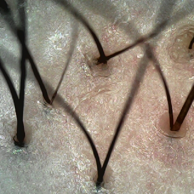 탈모 극복 프로젝트 - 정수리와 이마 사이 두피 모습이다.