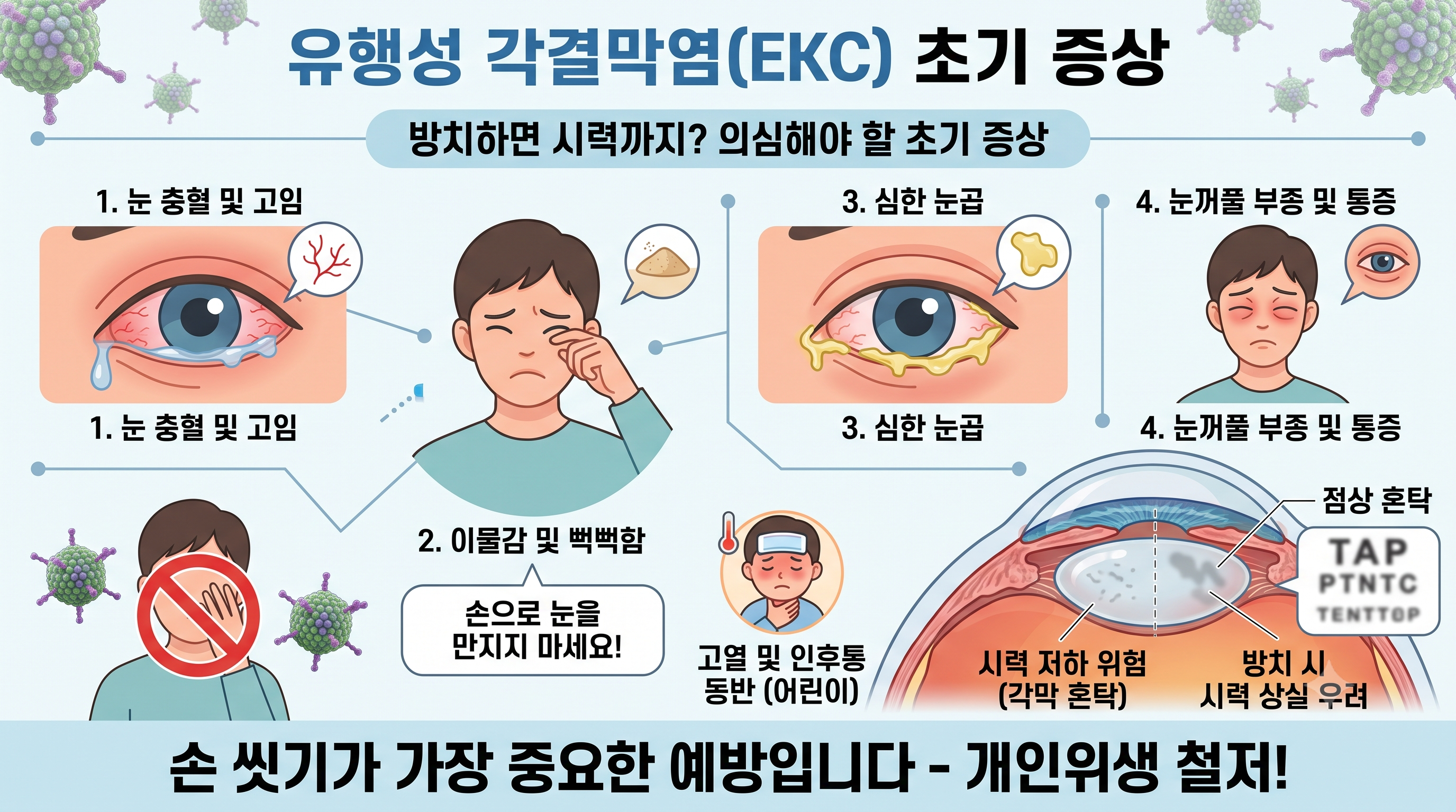 유행성 각결막염의 초기 증상