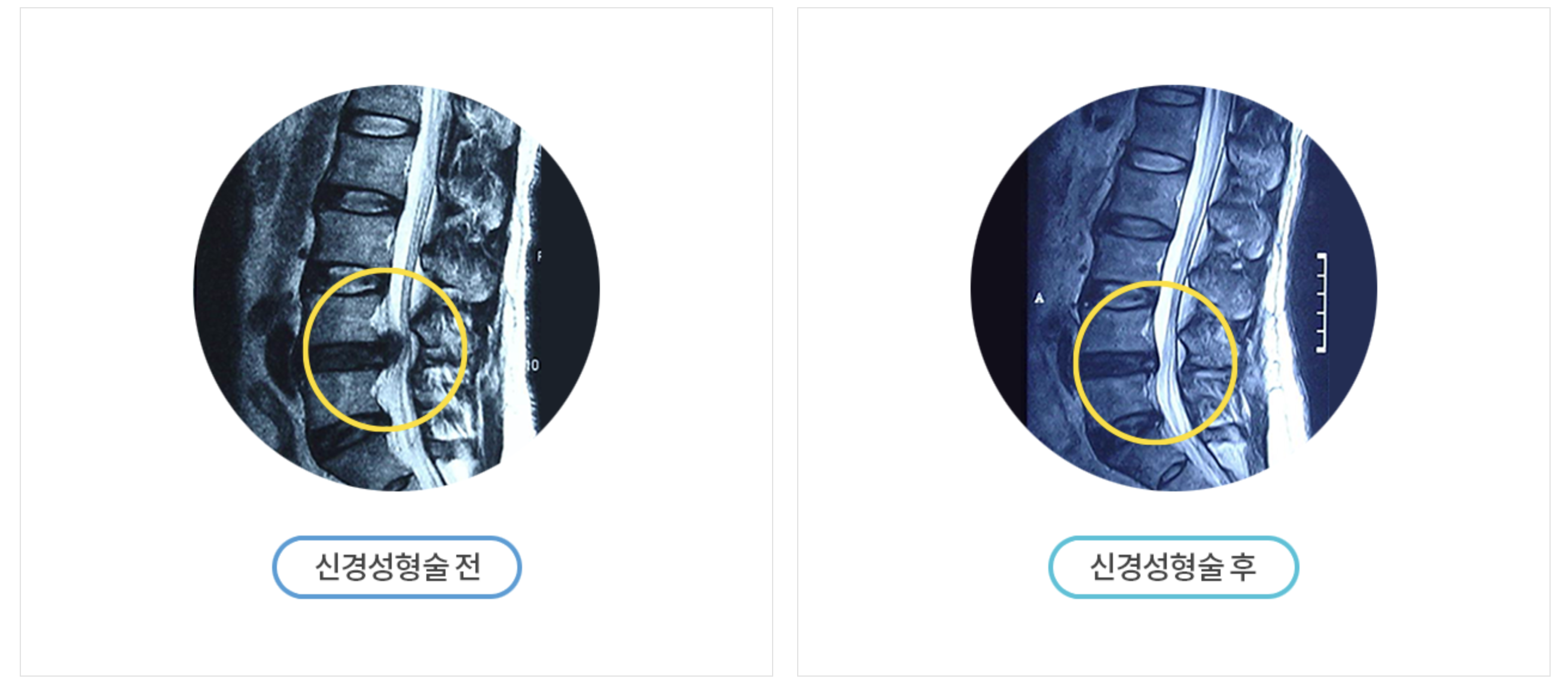 신경성형술 전_후