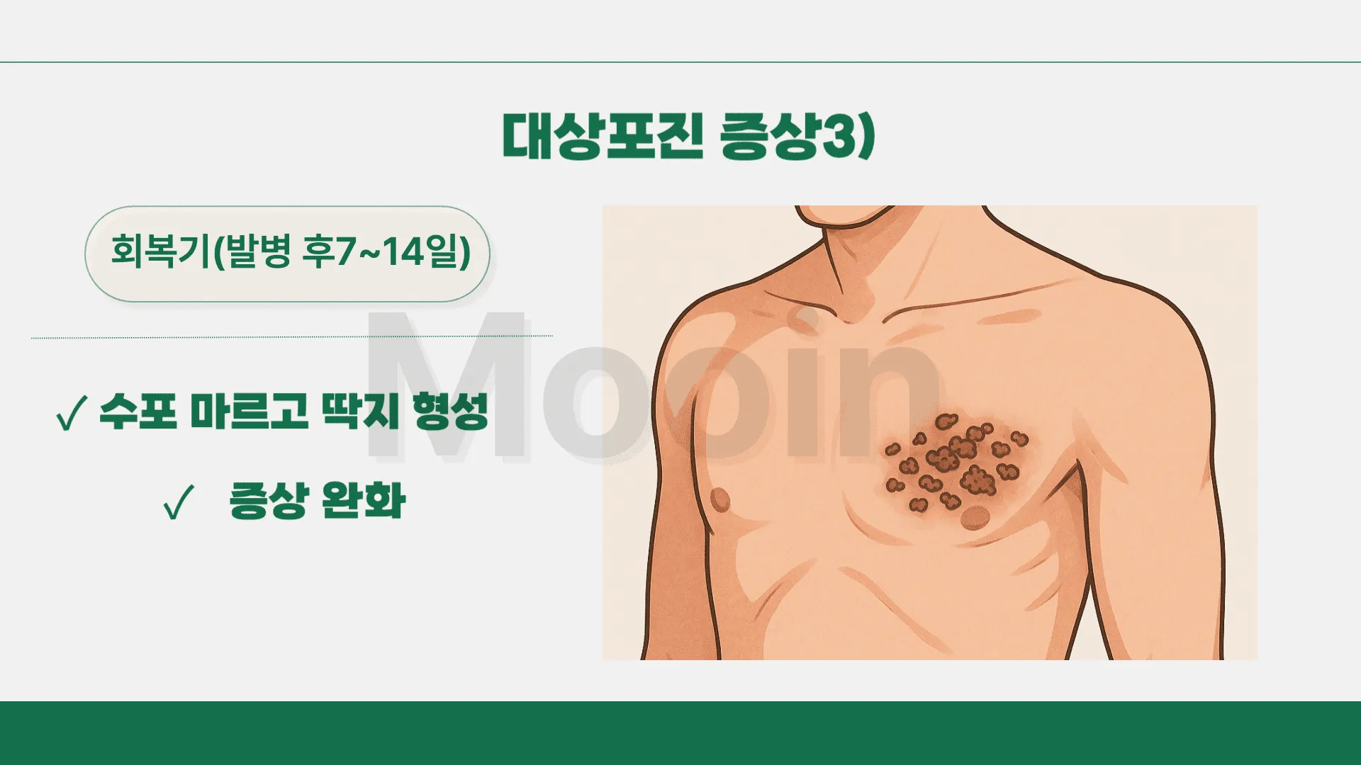 대상포진 증상3)