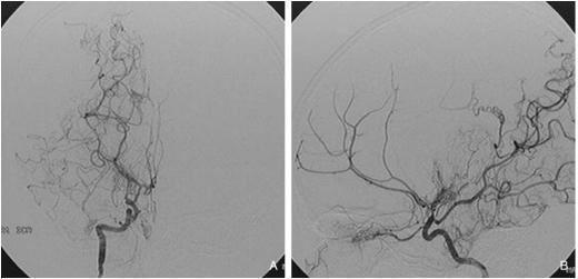 모야모야병 증상 사진