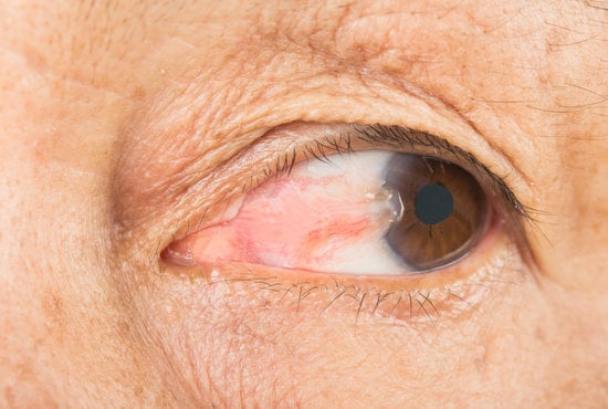 테리기움(Pterygium) &ndash; 원인, 증상, 치료법