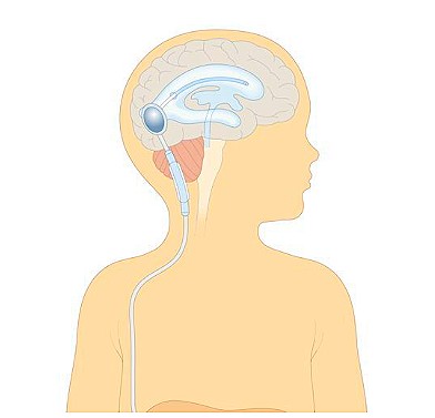 수두증 션트 수술