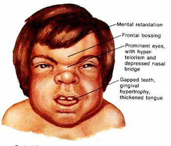 뮤코다당증(Mucopolysaccharidosis, MPS): 희귀질환의 이해와 간호적 접근
