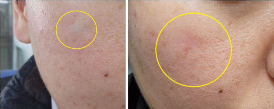 바시딘 비피큘크림 효과