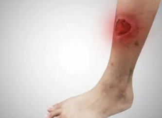 류마티스 관절염 초기증상 4