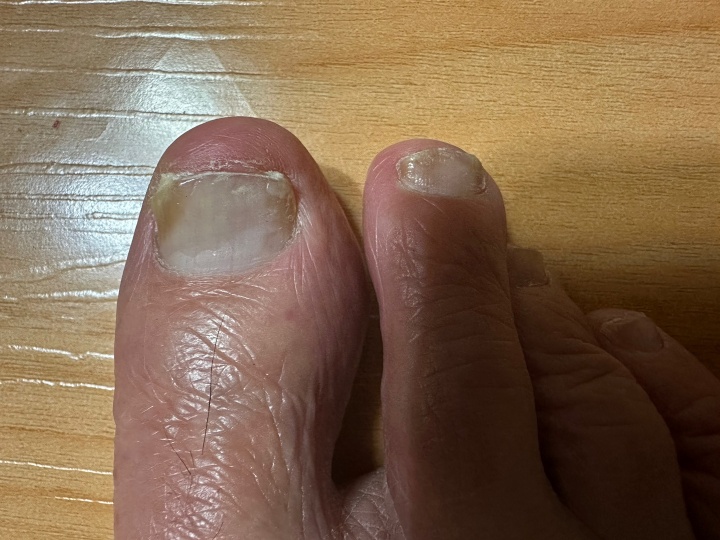 검게 변한 발톱&amp;#44; 어떻게 치료해야 할까?