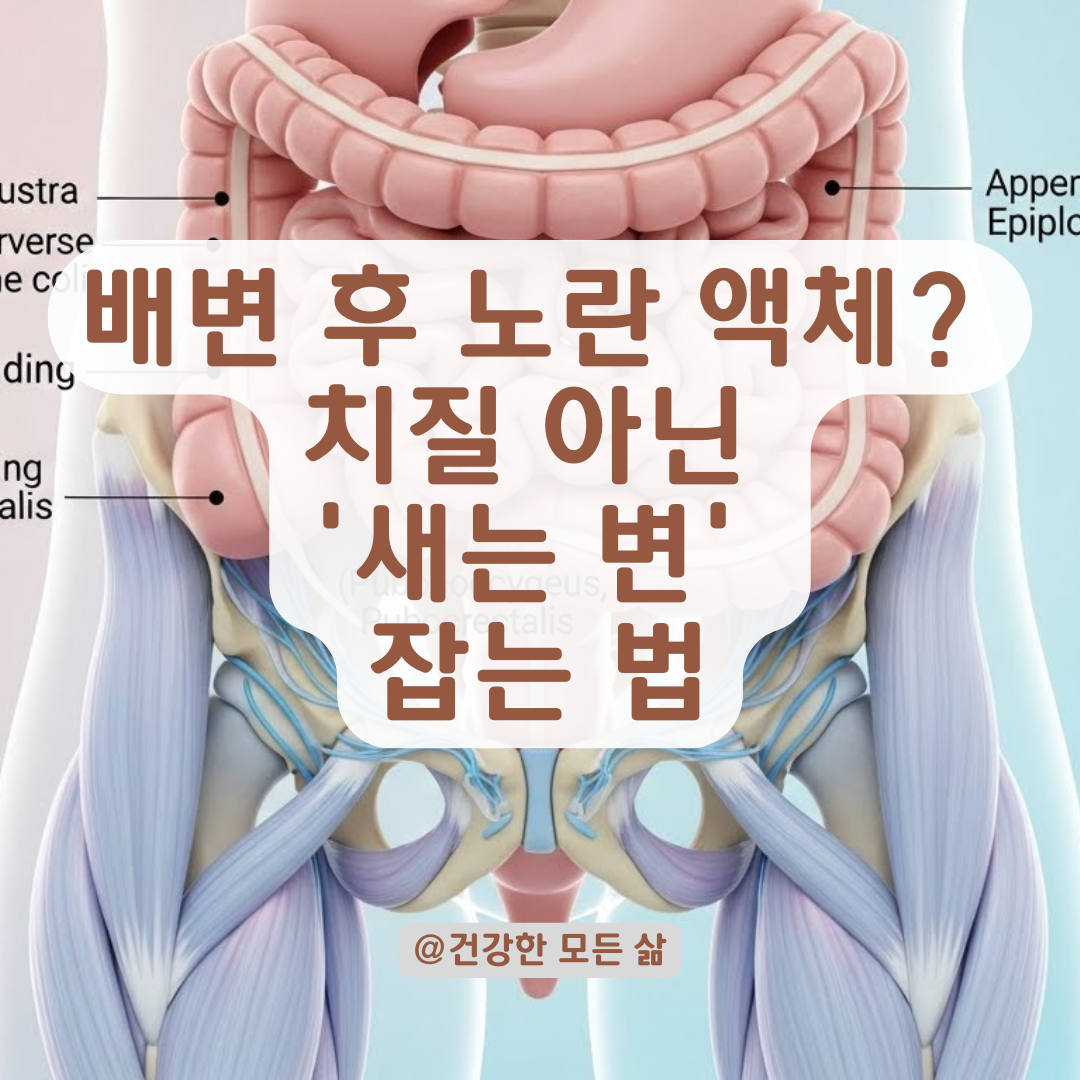 배변 후 찝찝한 잔변감과 노란 액체? 치질 아닌 '새는 변' 잡는 법.