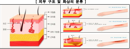 피부구조와-화상의-분류