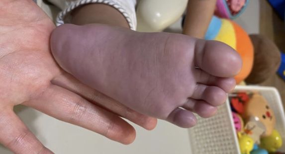 돌아기 청색증, 알아두면 우리 아이 지킬 수 있어요