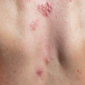 5. 콜린성 두드러기 완치 가능성