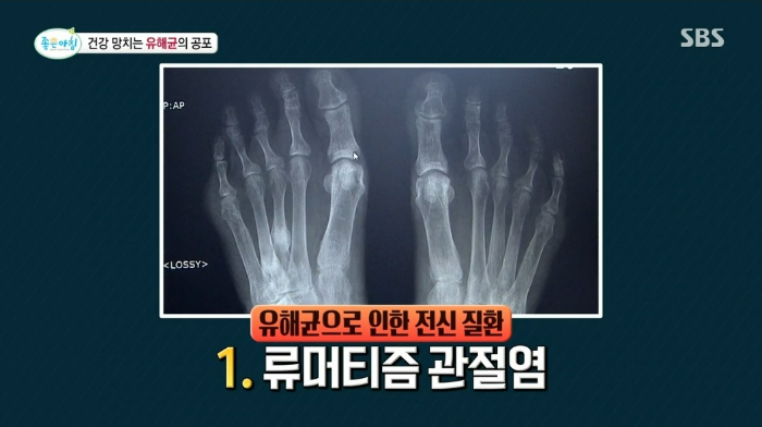 건강 망치는 유해균이 공포, 대장암 크론병 관절염 치매