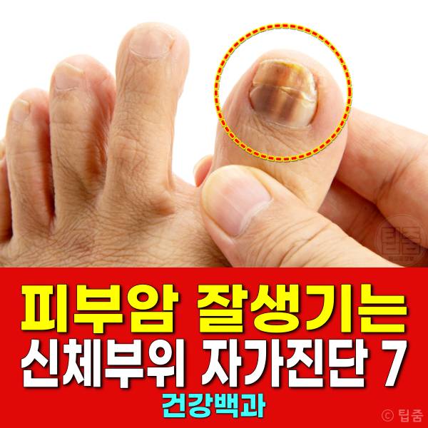 피부암 호발 부위 피부암자가진단 엄지발톱 손톱