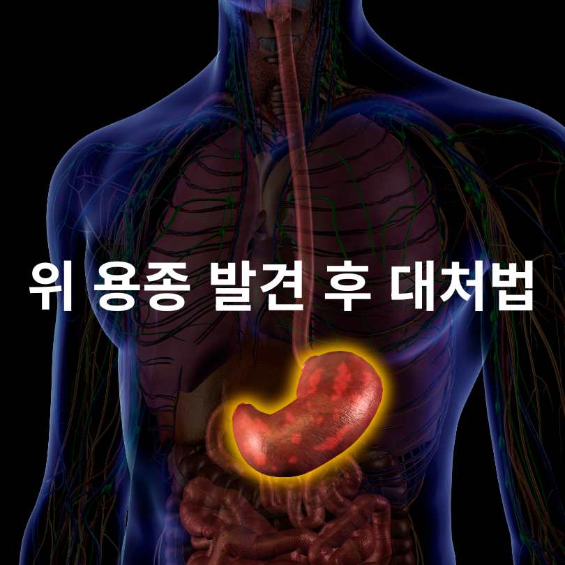 위 용종 암일확률? 걱정되는 분들을 위한 정확한 정보