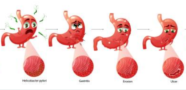 위암 초기증상, 수술비용, 수술후 회복기간 총정리 (2024ver)