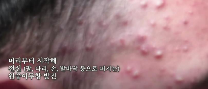 머리부터 시작된 원숭이두창모습