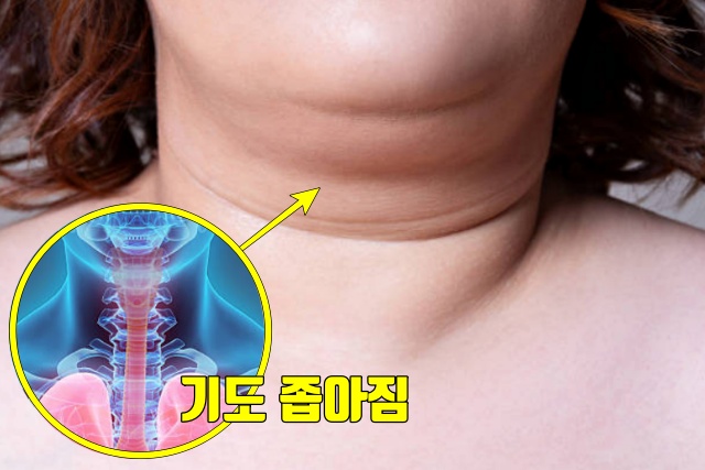 코골이 줄이는 방법 기도가 막히는 수면무호흡증, 내장지방 빼는법, 다이어트 건강 팁줌 매일꿀정보