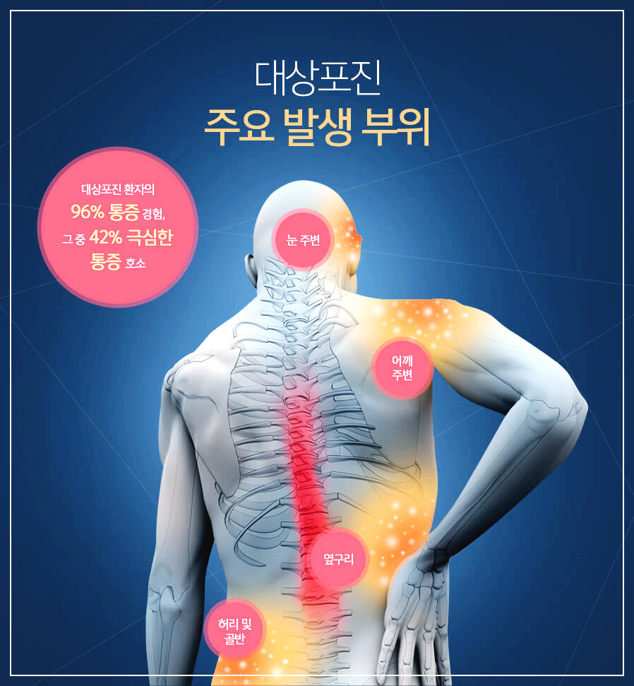 대상포진 예방접종
