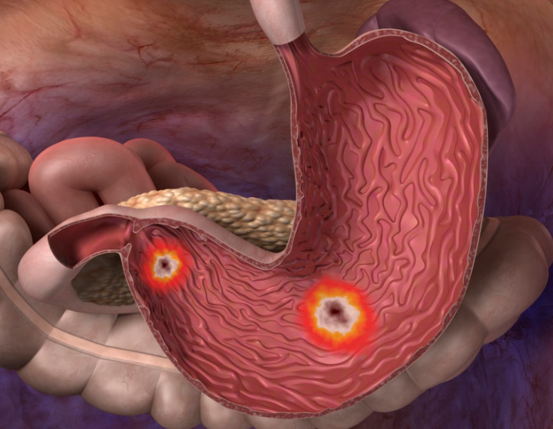 위염으로 인한 합병증