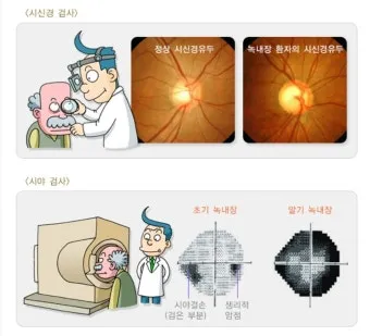 녹내장 진단 검사 비용 안압 검사주기 관리법_5