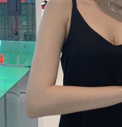 팔뚝 지방분해 주사 후기