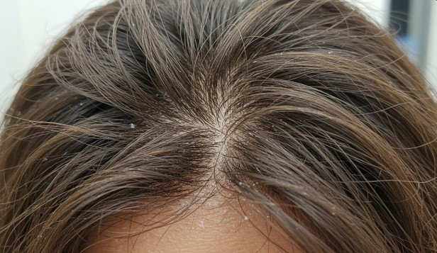 비듬이 심해지는 계절은? 여름 vs 겨울 원인 비교 총정리!