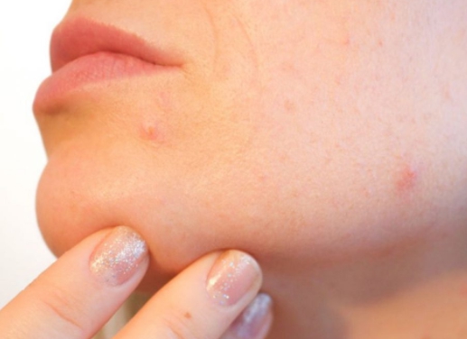 부위별 여드름 원인