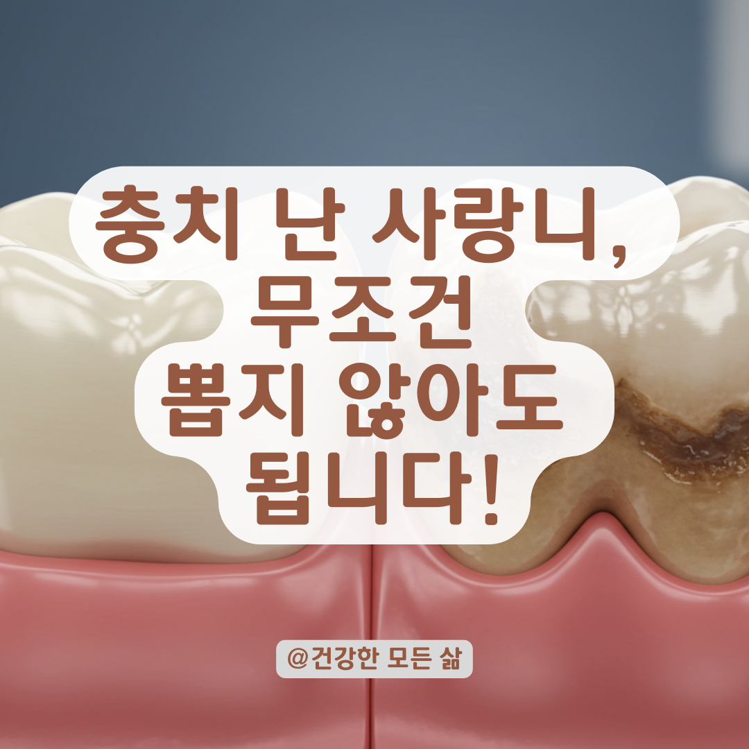충치 생긴 사랑니는 무조건 발치? 치아 상태별 치료 선택지 정리.