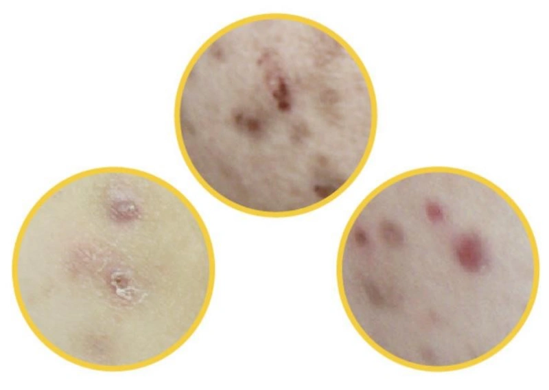 화농성 한선염 주요 증상