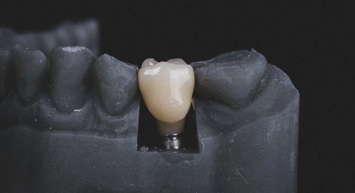 implant