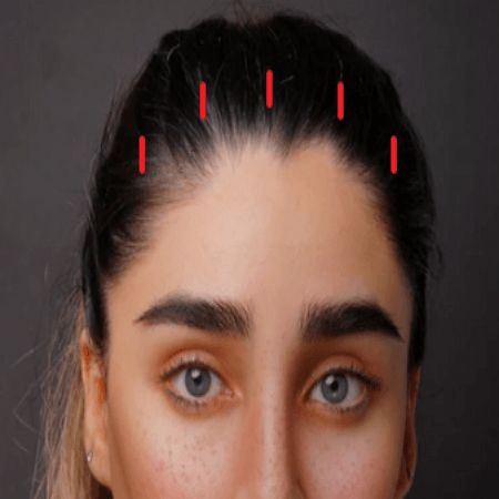 현재 내시경 이마거상술 절개 방식