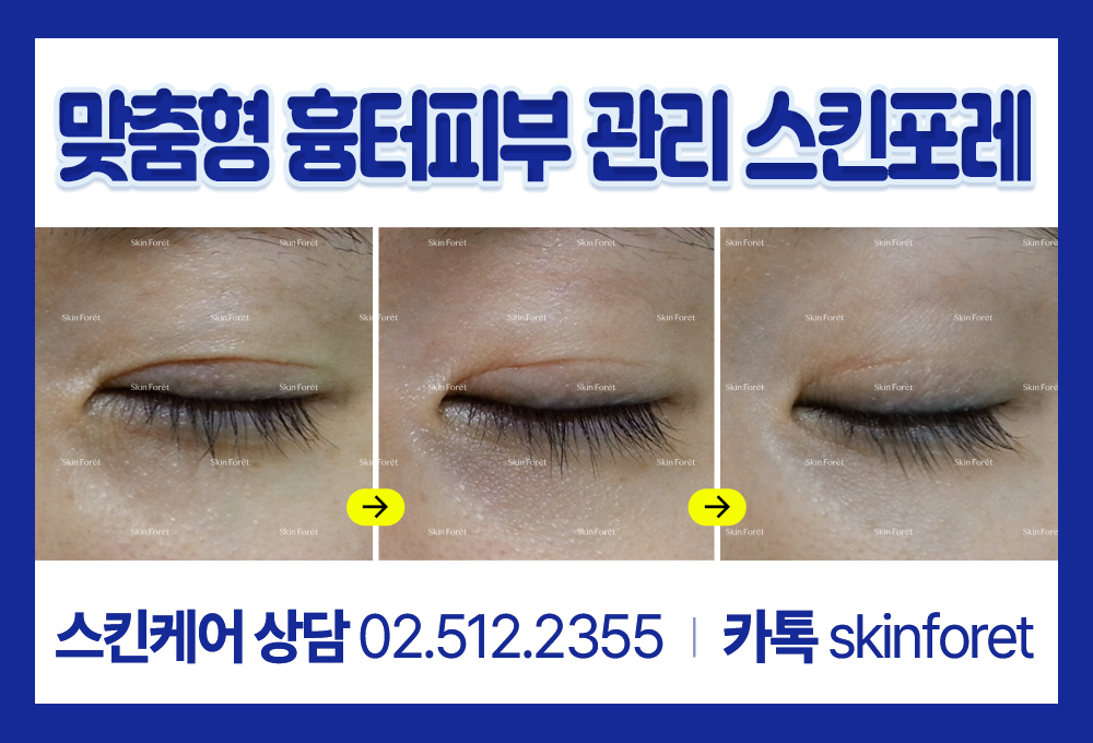 기기 없이 민감한 눈가 흉터를 케어하는 독자적인 프로그램 케어 과정 결과