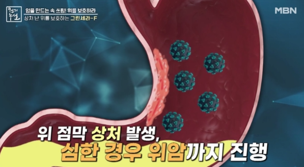 그린세라-f-효능-부작용-위암-예방