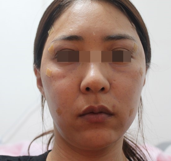 얼굴지방이식후기