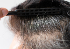 탈모 증상 이미지