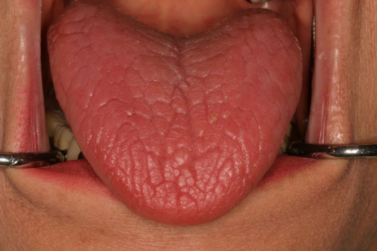 구강건조증으로 병원을 찾은 환자의 입안사진