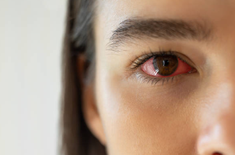 안구 건조증 증상