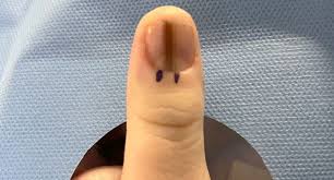 손톱 세로줄이 나타나는 이유와 관리법