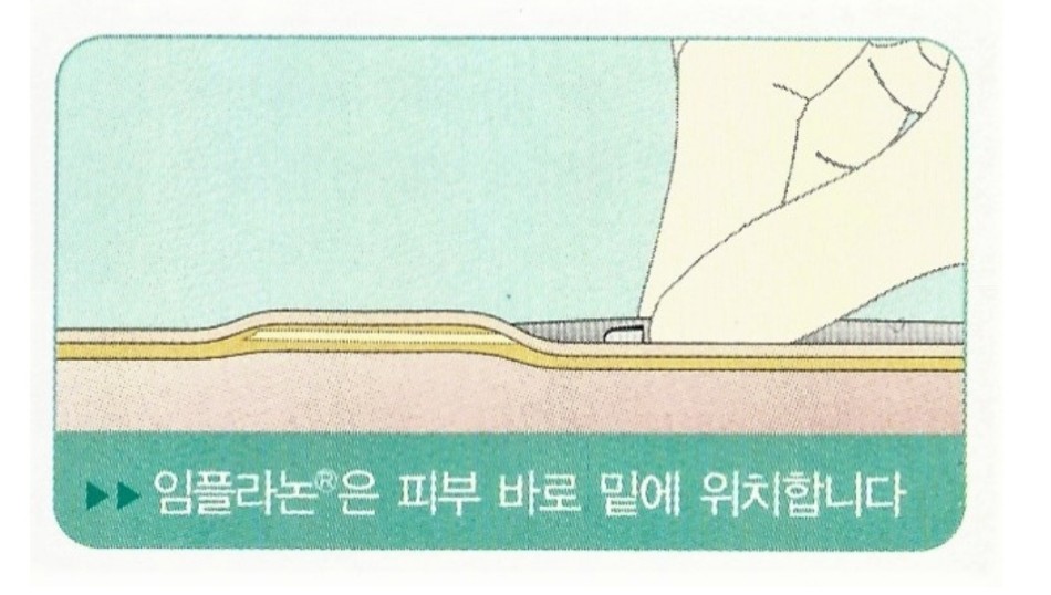 임플라논