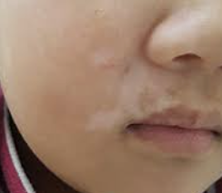 백반증 초기증상 13