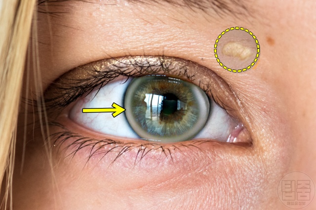 고지혈증 증상 초기증상 눈동자 흰고리 고지혈증원인