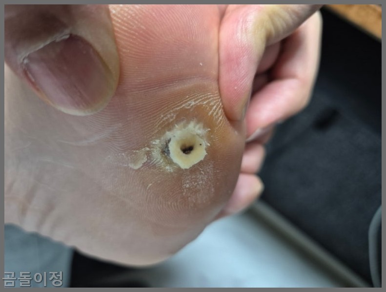 발바닥 티눈 치료법부터 재발 방지까지, 실제 후기로 정리한 팁