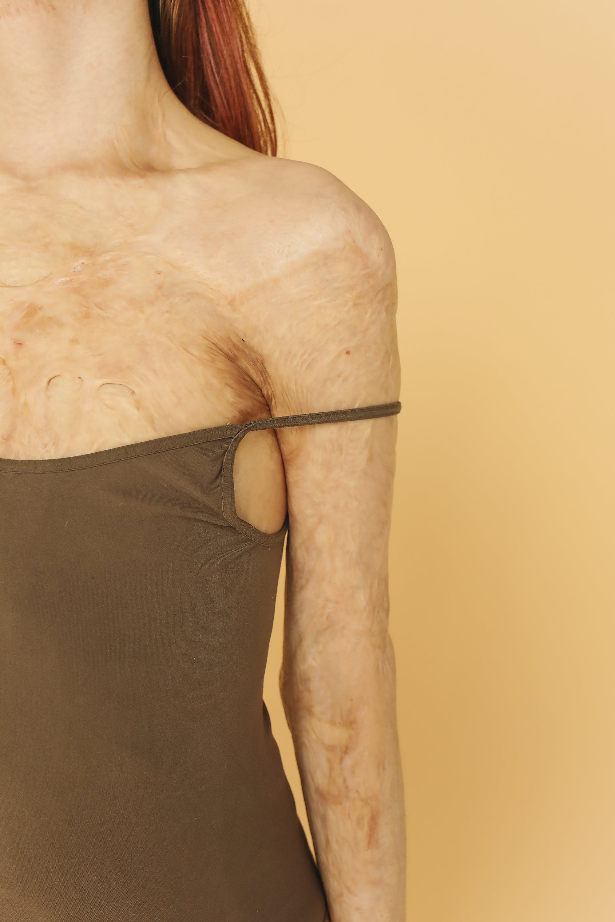 화상에 좋은 음식